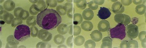 Illustrative Examples Of The Large Granular Lymphocytes A Large