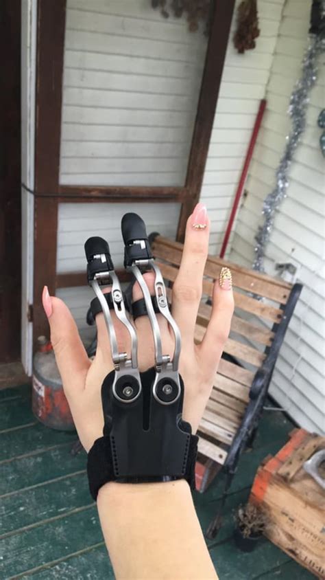 Woman Who Lost Fingers In Woodworking Accident Gets Prosthesis New Outlook On Life