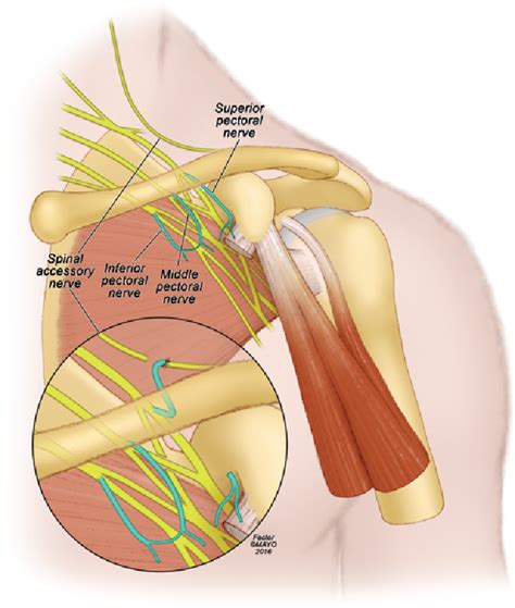 Figure From Lateral Pectoral Nerve Transfer For Spinal Accessory