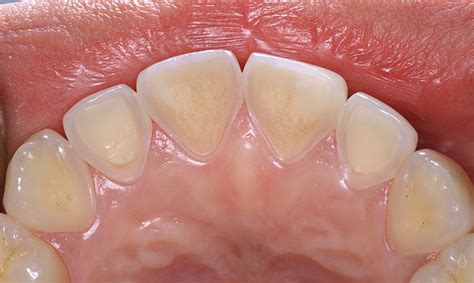 Enamel Erosion What Is It And Why Is Tooth Erosion So Commonenamel