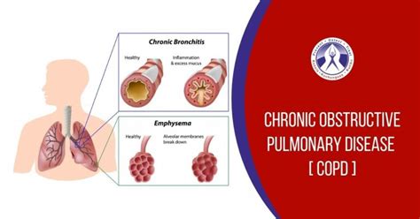 AN INFORMATION GUIDE TO CHRONIC OBSTRUCTIVE PULMONARY DISEASE