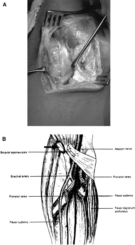 Acute Compression Of The Median Nerve At The Elbow By The Lacertus