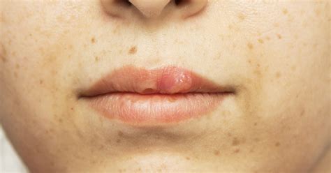 Small Red Bumps Around Mouth Livestrongcom