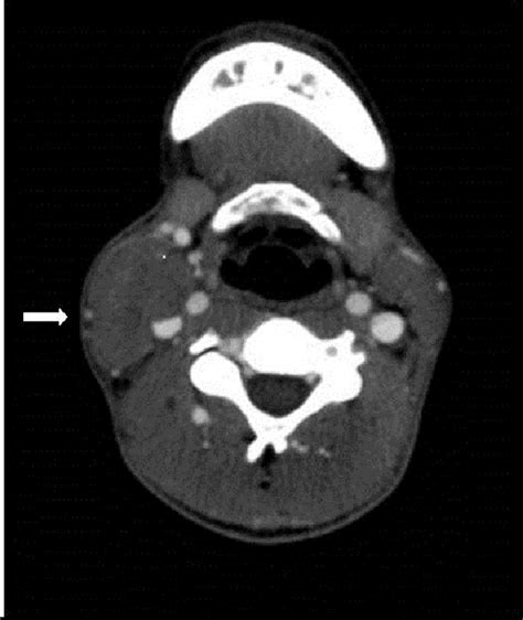 A Contrast Ct Scan At The Level Of The Bifurcation Of The Right Common