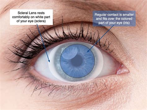 Scleral Contact Lenses Focal Pointe Eye Care