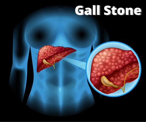 Gall Stone Polyp Types Causes And Symptoms Homeo Care Clinic