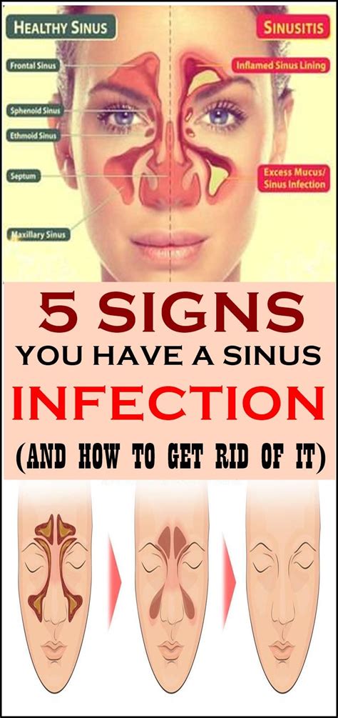 5 Signs You Have A Sinus Infection And How To Get Rid Of It Sinus