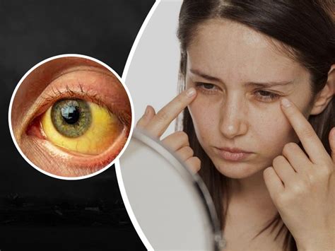 Jaundice Symptoms Causes Risk Factors And Treatment Onlymyhealth
