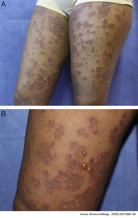 Erythema Multiforme Like Bullous Pemphigoid Actas Dermo Sifiliográficas