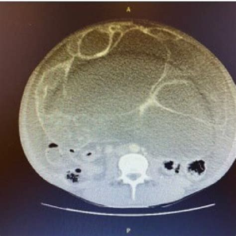 Ct Scan Showing Huge Multiseptated Cystic Intra Abdominal Mass