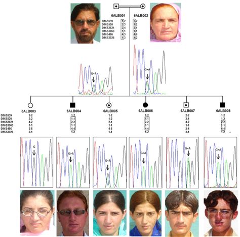 Mc1r Gene Mutation And Its Association With Oculocutaneous Albinism Type Oca Phenotype In A