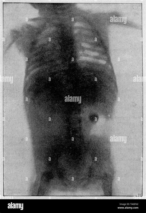Child Swallowed Coin Black And White Stock Photos And Images Alamy