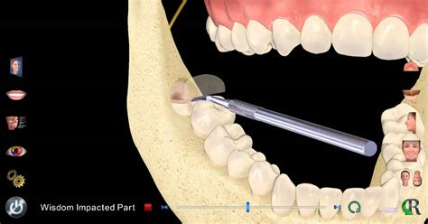 Upper Wisdom Tooth Extraction Ph