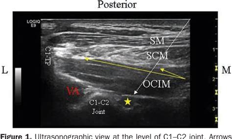 Figure 1 From Ultrasound Guided Pulsed Radiofrequency Of C2 Dorsal Root