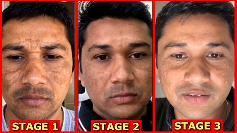 3 Stages Of Pigmentation How To Cure Melasma Youtube