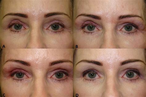 Upper Eyelid Hollows Or Sunken Eyelids After Blepharoplasty Surgery