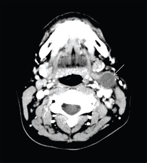 Axial Contrast Enhanced Ct A 2 Cm Well Circumscribed Open I