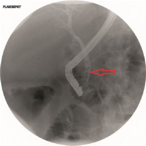 Ercp Shows Multiple Stones In The Common Bile Duct Red Arrow