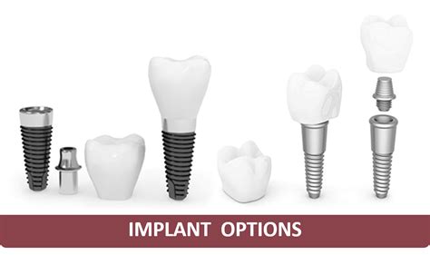 Dental Implants Docdentalsmile