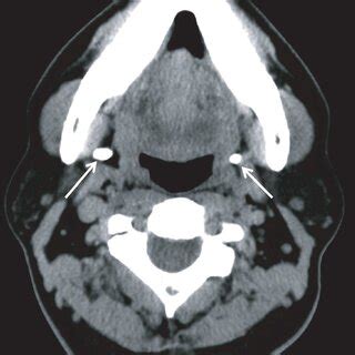CT Revealed Ossification Of The Bilateral Stylohyoid Ligaments