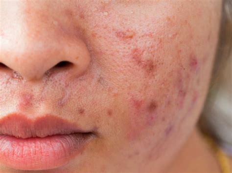 If you notice raised red bumps that feel tender to the touch and seem rooted deep beneath your skin, it's probably cystic acne. How To Get Rid Of Cystic Acne | What Causes Cystic Acne?