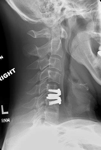 Artificial Disc Replacement Adr Spine Surgeon