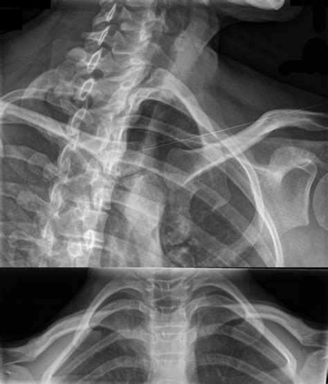Instability Of The Sternoclavicular Joint Bone And Joint