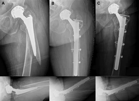 Modified Extended Trochanteric Osteotomy For The Treatment Of Vancouver