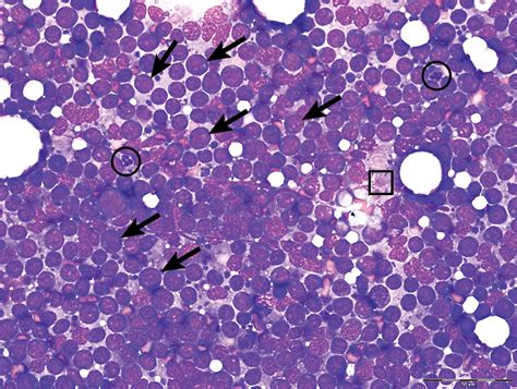 Reactive Lymph Node Cytology