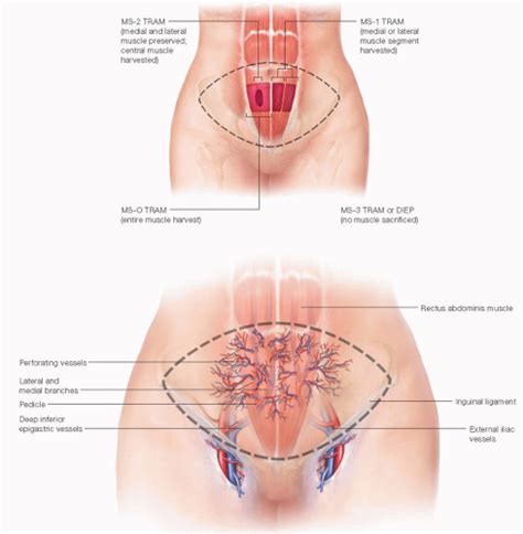 Free Transverse Rectus Abdominis Musculocutaneous Flap Reconstruction