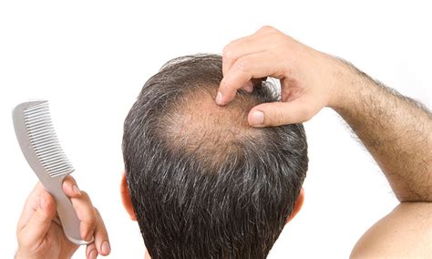 Which Vitamin Deficiencies Can Lead To Hair Fall Dr Batras