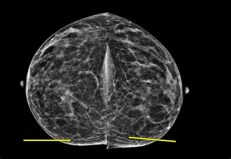 Cureus A Breast Imaging Case Of Steatocystoma Multiplex A Rare