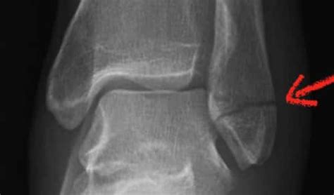 Lateral Malleolus Fractures Symptoms Treatment Recovery Time