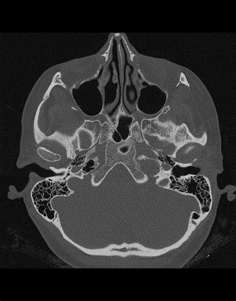 Clinical Case Incidental Finding After Head Trauma
