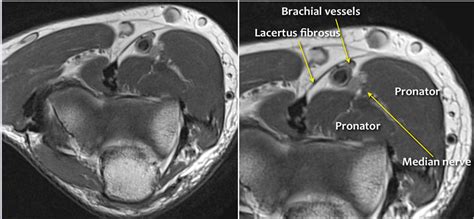 Mri Anatomy Axial Cross Sectional Anatomy Of Elbow Joint Mri Radial