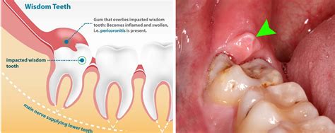 Before buying yourself with numbing gel from pharmacies or online stores, make sure to check if you're allergic to benzocaine, as this ingredient is the one used to reduce the pain and discomfort caused by the wisdom tooth. Wisdom tooth extraction or removal surgery treatment Pune ...