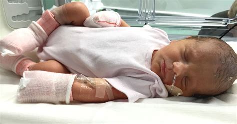 Distraught Mum Couldnt Cuddle Newborn Daughter For Five Months Because Tots Skin Would Fall