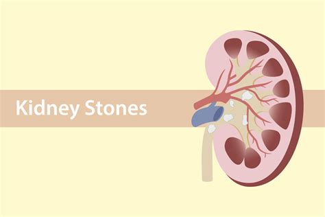 Kidney Stones Whats Your Risk