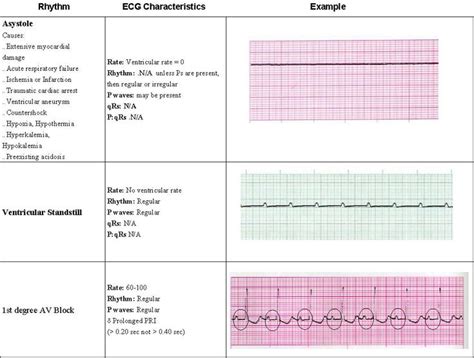 Acls Rhythms Pg 6 Of 7 Paramedic Quotes Cardiac Nursing Nurse Life
