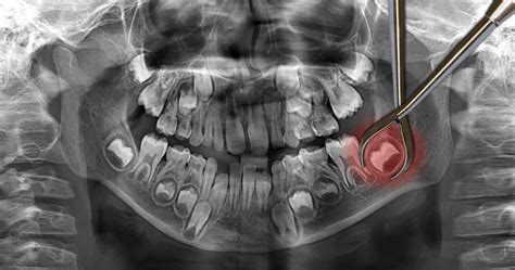 Surgical Tooth Extractions Poulos Somers