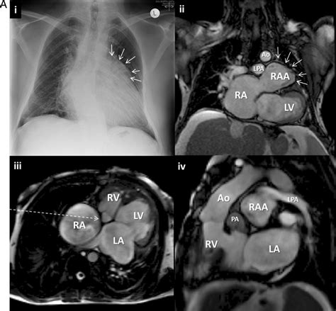 A Patient 2 Imaging Findings I Chest Radiography In Download