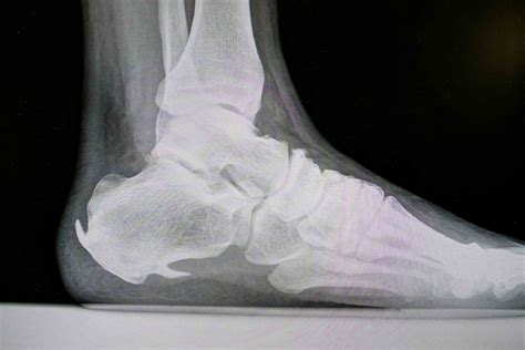 Heel Pain Heel Spur Plantar Fasciitis Friendly Foot Care Pc