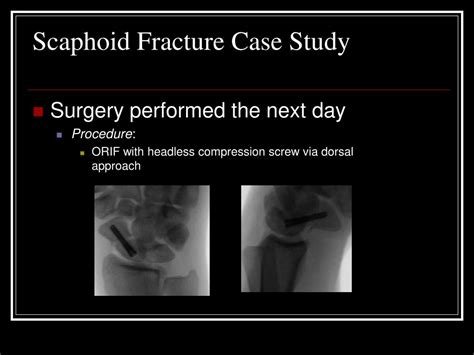 PPT - Scaphoid Fracture Case Study PowerPoint Presentation ...