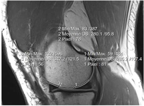 T2 T2 Mri Mapping In The Knee Articular Cartilage At 15 Tesla And 3 Tesla