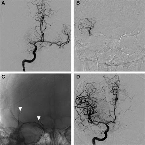 Techniques For Endovascular Treatment Of Acute Ischemic Stroke Stroke