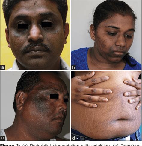Figure 1 From A Descriptive Study Of Facial Acanthosis Nigricans And