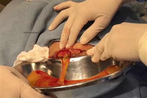 Dr Pimple Popper Drains Huge Cyst On Mans Bum In Gruesome