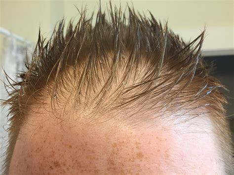 Min Beforeafter Hairline For Diffuse Thinning Tressless