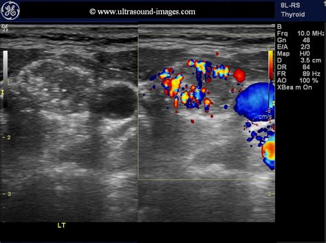 It gradually deteriorates the function of healthy cells the thyroid gland is part of the endocrine system, which regulates hormones in the body. A Gallery of High-Resolution, Ultrasound, Color Doppler ...