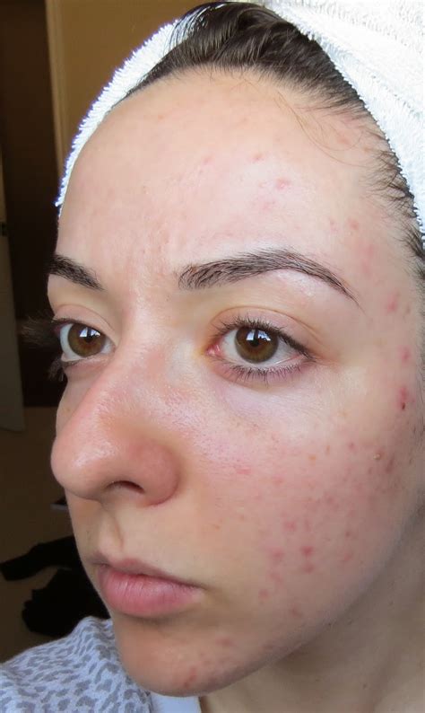 My Skins Journey Week 19 Banish Acne Scars